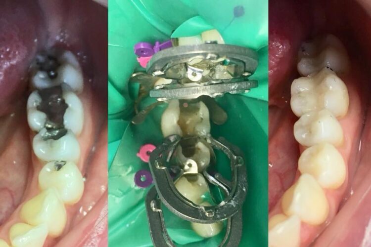 fotky zubů před a po opravě