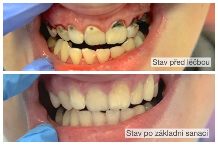 Oprava kazů na předních zubech